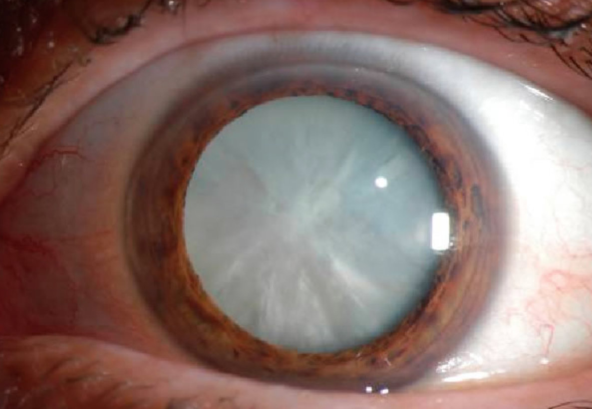 Cataract