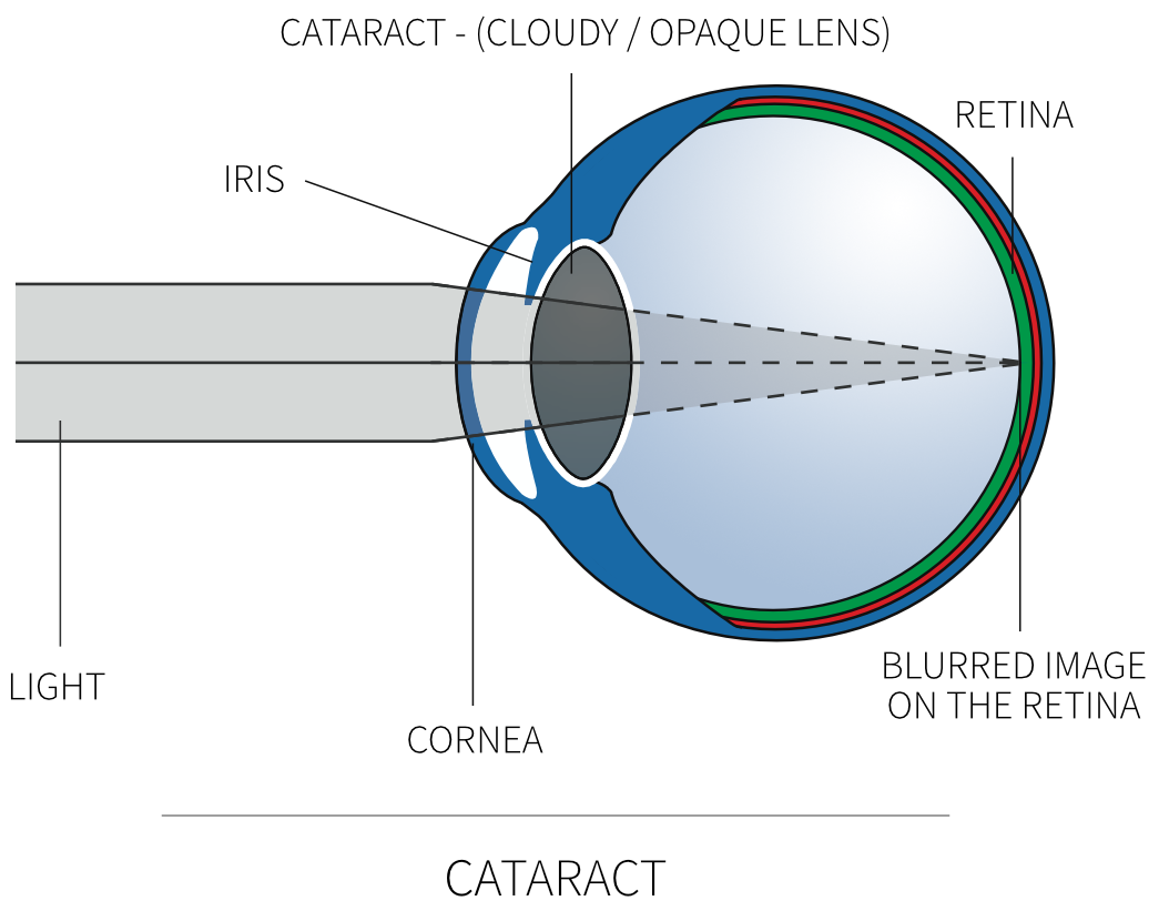 cataract surgery