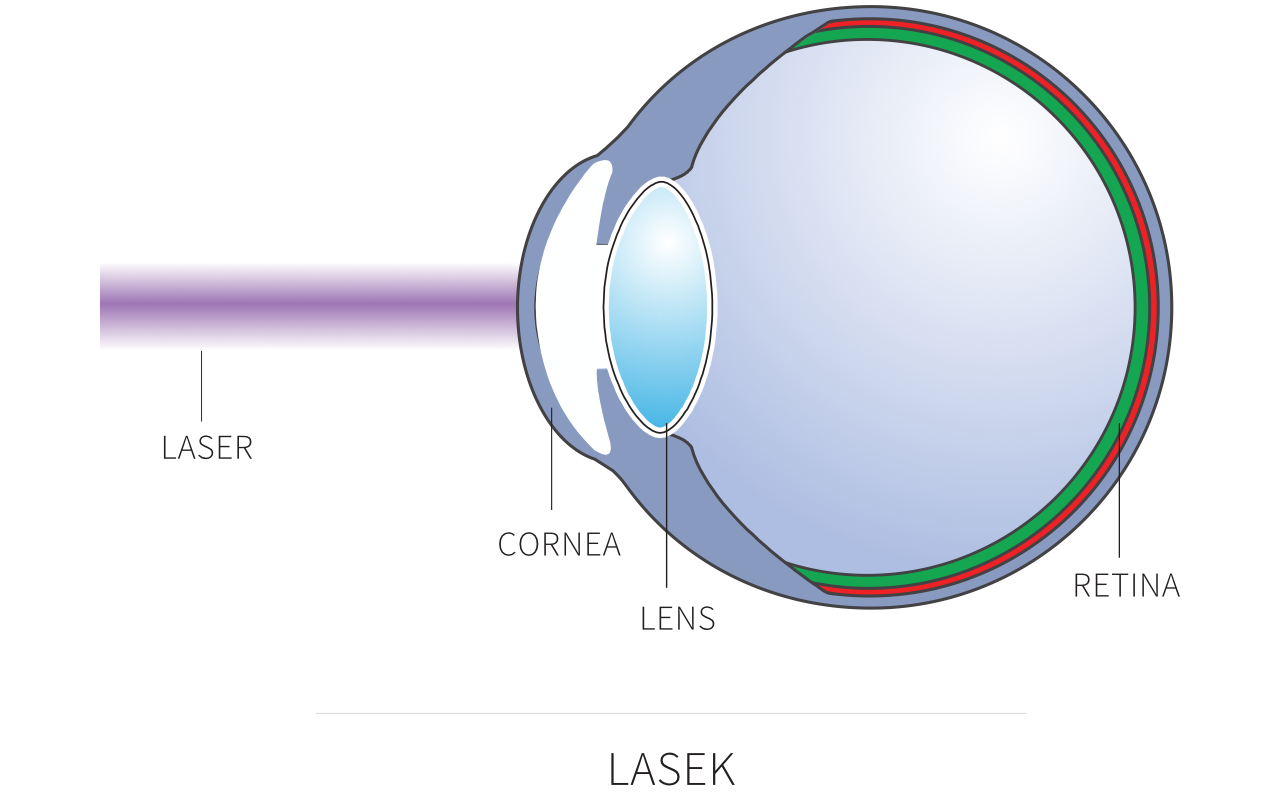 LASEK laser eye - The Wimpole Eye Clinic