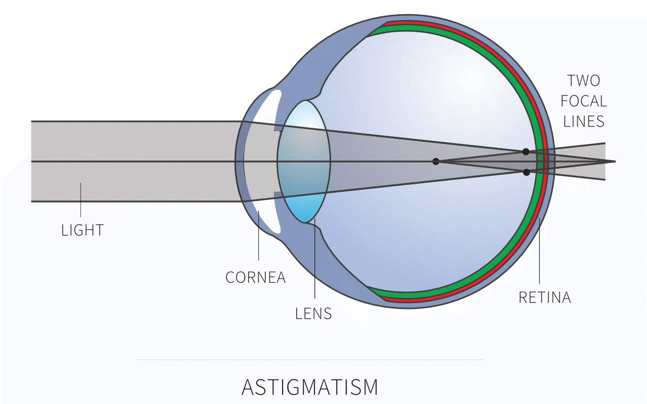 Фокусировка лучей света на внутренней поверхности. Рефракции астигматизм зрения. Зрение 2.5 астигматизм. Рефракция хрусталика. Соразмерная рефракция глаза.