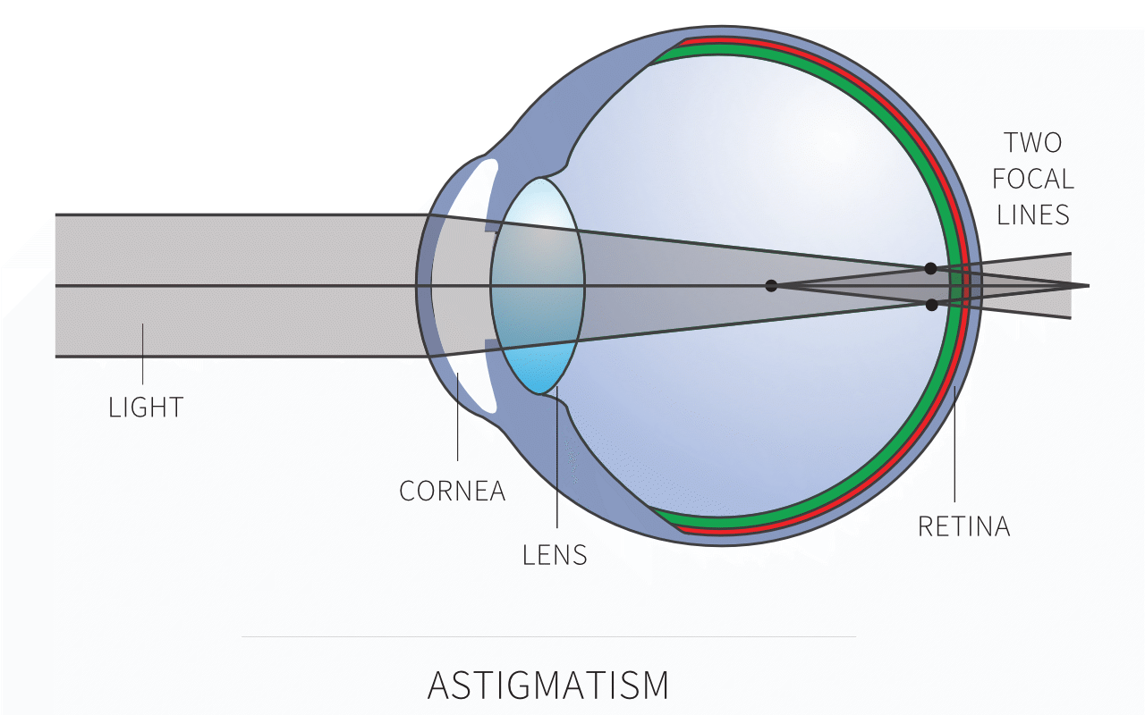 astigmatism-david-gartry