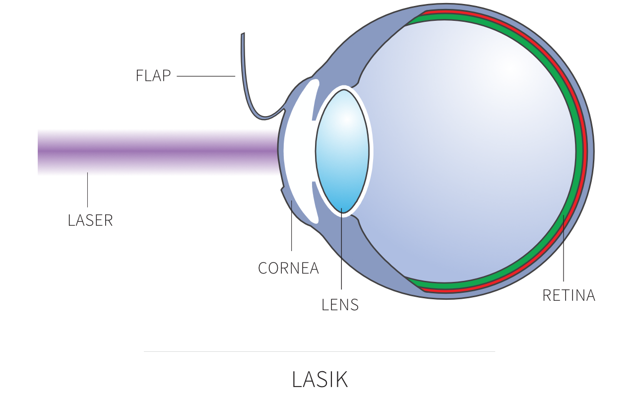 Diagram showing LASIK laser eye surgery