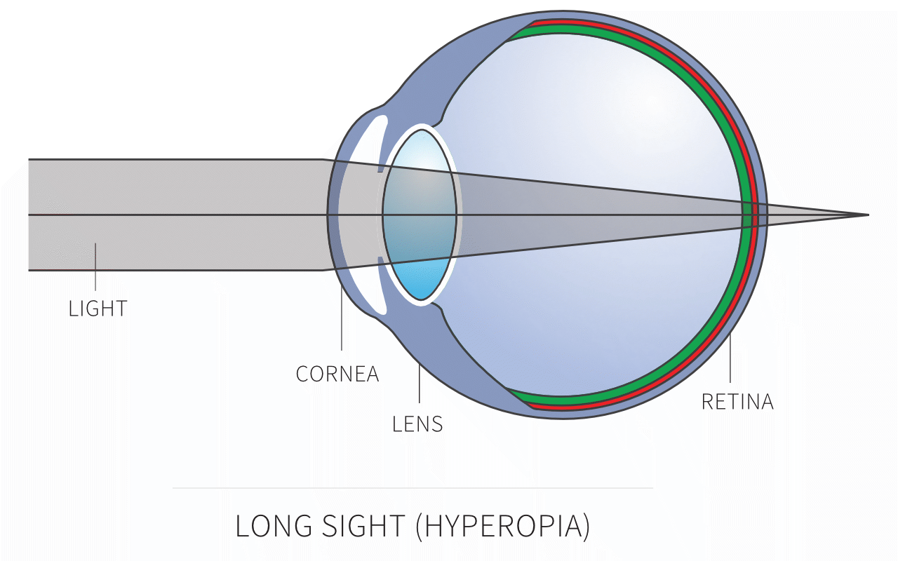 hypermetropia lens)