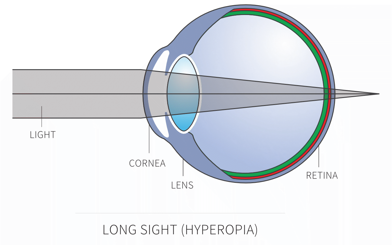 What Is Long Sighted Vision