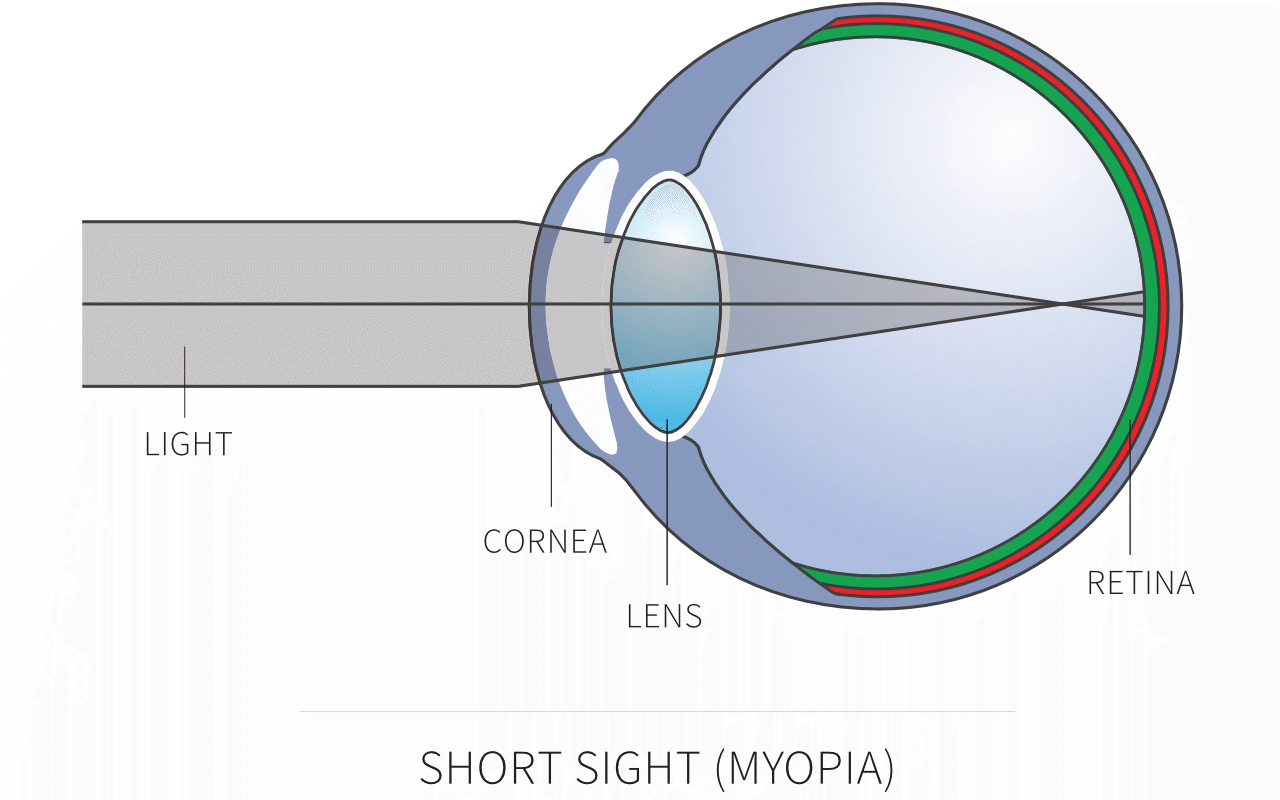 what makes a person near sighted